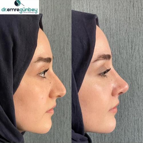 عملية تجميل الأنف صور قبل وبعد